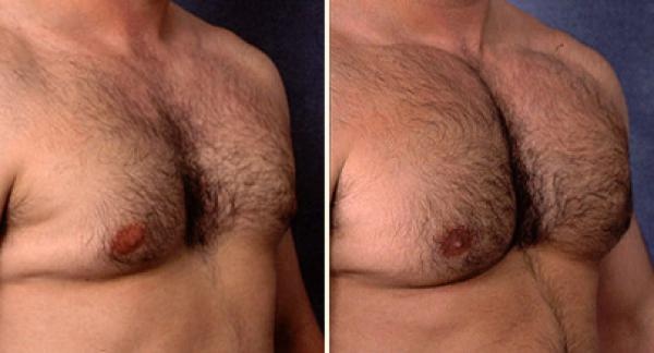 Как увеличить количество волос на груди мужчины