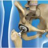 Ортопедия в Германии: особенности эндопротезирования сустава